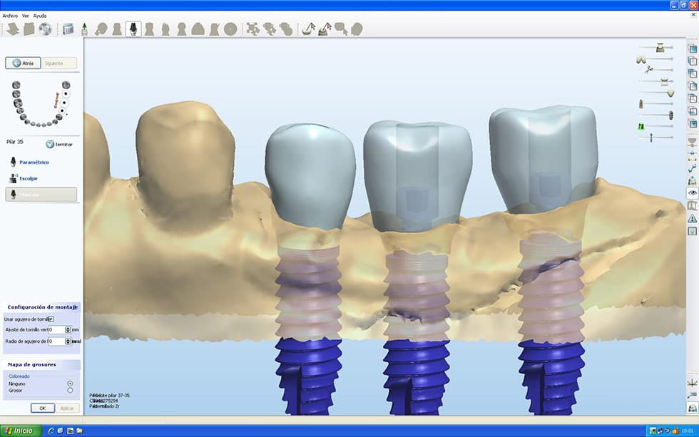 CAD-Software für Implantatplanung