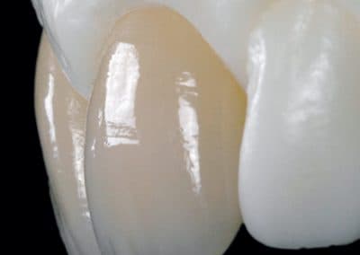 Vollkeramik Restauration