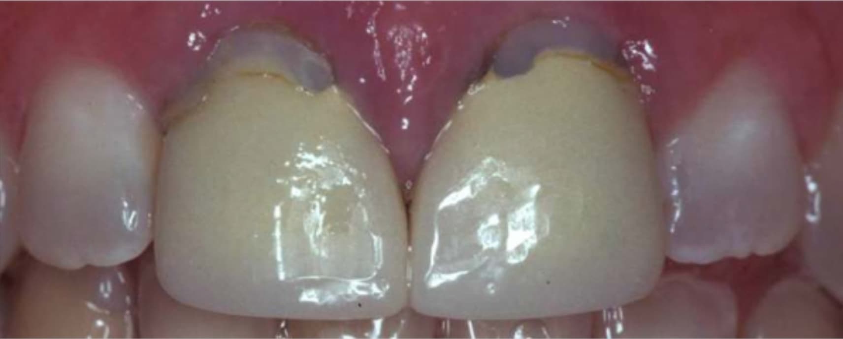 Vorher: Defekte VMK-Kronen